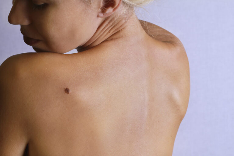Rak skóry – Przyczyny, Objawy i Rozpoznanie